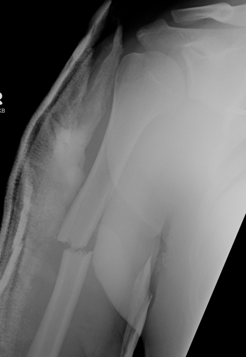 Undisplaced Humeral Fracture AP